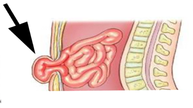ما هو الفتق السري | اعرض وانواع وتشخيص وعلاج الفتق السري عند الاطفال ومريض الكبد من الرجال والنساء