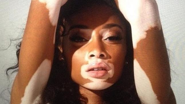 تفسير حلم رؤية البهاق فى المنام