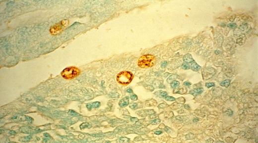 جراثيم البريمية تشخيصها وعلاجها