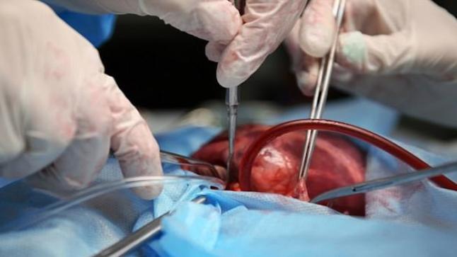 رفض الأعضاء المزروعة