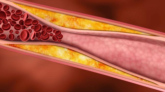 تصلب الشرايين وأعراضه والوقاية منه