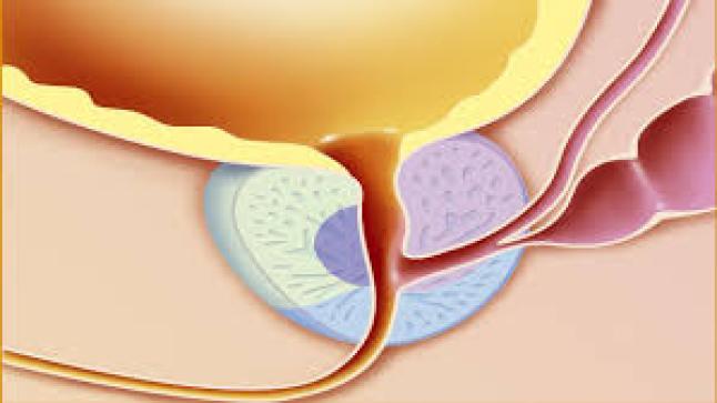 التهاب البروستاتا أعراضها وأسبابها
