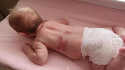 خلل التنسج الوعائي