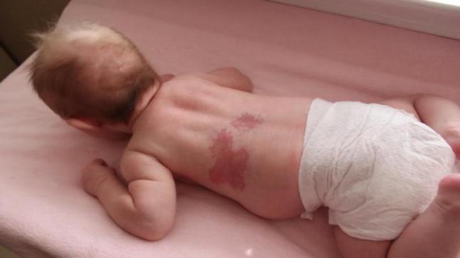 خلل التنسج الوعائي