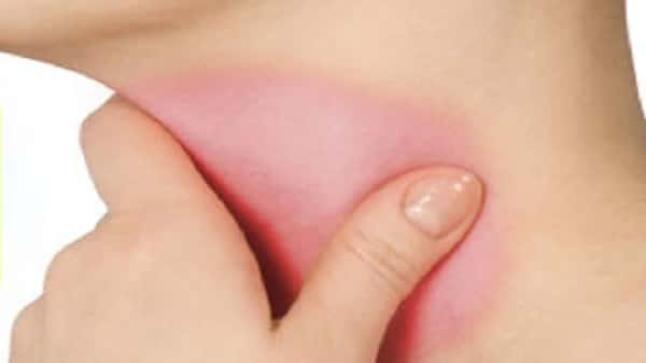 التهاب البلعوم الحاد | أعراضه وأسبابه وتشخصيه وطرق علاجه