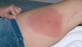 المكورات العنقودية.. عدوى تثير القلق في بريطانيا