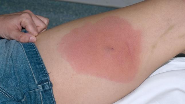 المكورات العنقودية.. عدوى تثير القلق في بريطانيا