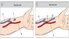 تحويلة وعائية