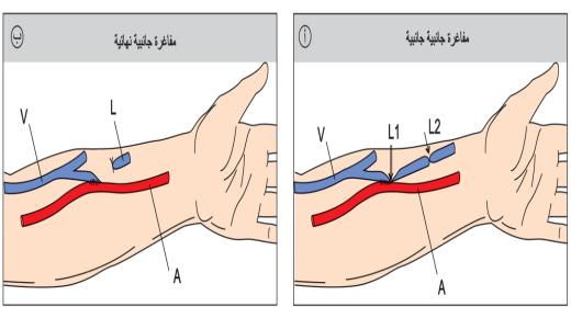 تحويلة وعائية