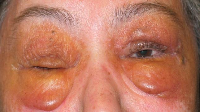 الداء النشواني