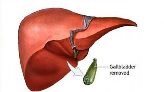 تشمع المرارة الأولي