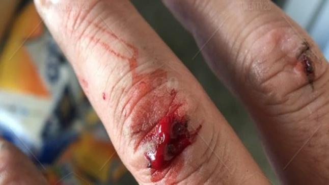 تفسير حلم الجرح من الشوك في المنام