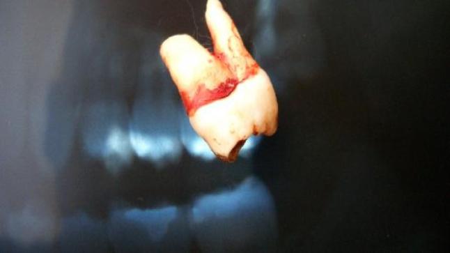 تفسير سقوط الضروس في المنام