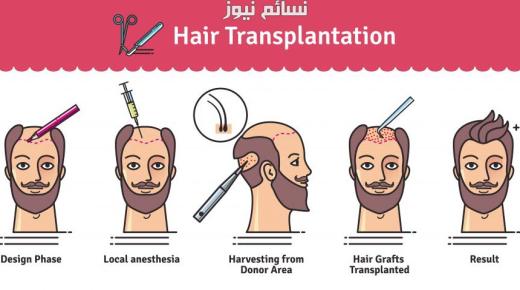 تكلفة زراعة الشعر في تركيا بالريال السعودي