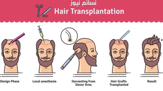 تكلفة زراعة الشعر في تركيا بالريال السعودي