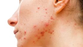 لبشرة أكثر نقاء.. وصفات طبيعية لعلاج حب الشباب