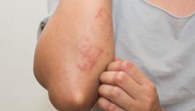 الساركويد أعراضه وعلاجه