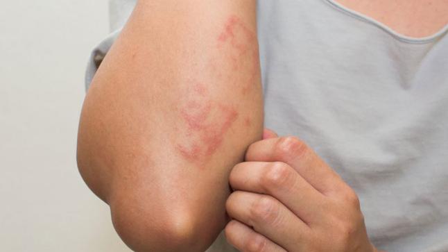 الساركويد أعراضه وعلاجه