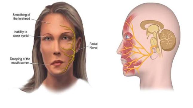شلل العصب الوجهي أعراضه وعلاجه