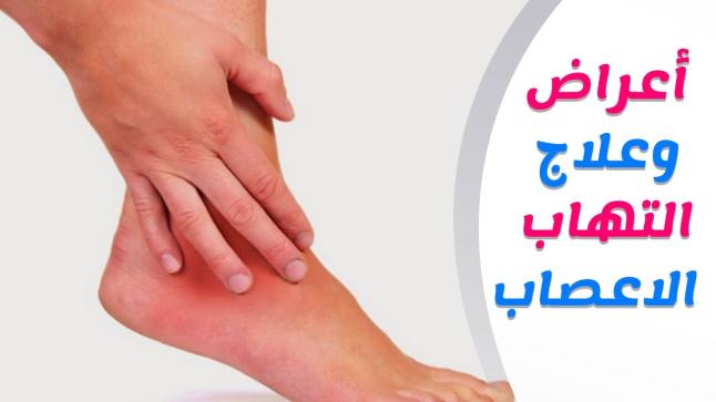 علاج التهاب الاعصاب بالأعشاب
