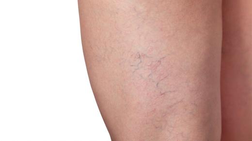 علاج الدوالي بالاعشاب | اعراض وعلاج مرض الدوالي للنساء الحوامل والرجال في الخصيتين