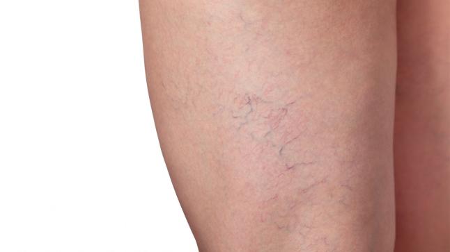 علاج الدوالي بالاعشاب | اعراض وعلاج مرض الدوالي للنساء الحوامل والرجال في الخصيتين