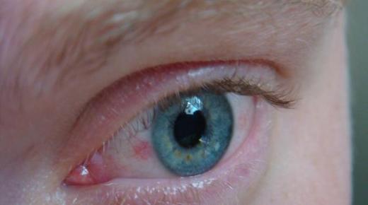 علاج ضغط العين بالأعشاب