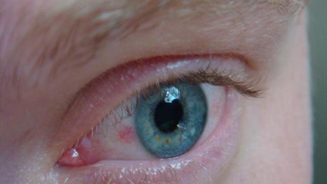 علاج ضغط العين بالأعشاب