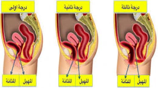 قيلة مثانية وأعراضها وطرق علاجها