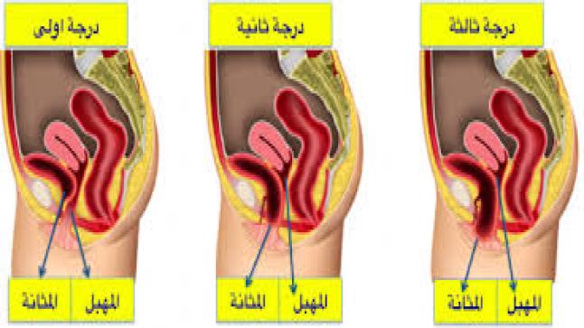 قيلة مثانية وأعراضها وطرق علاجها