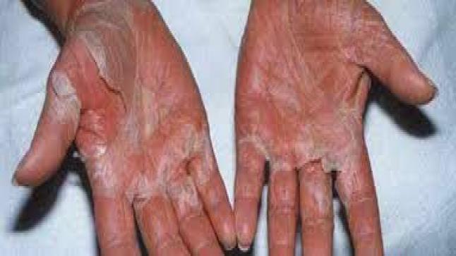 متلازمة الصدمة السامة وأعراضها