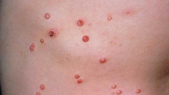 الجرب تشخيصه وأسبابه وعلاجه وكيفية الوقاية منه