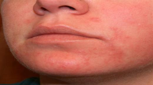 مرض الذئبة Lupus علاجه ومضاعفاته