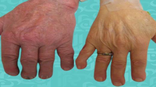 استشاري يكشف أسباب إصابة الإنسان بمرض ترسب الأصبغة الدموية