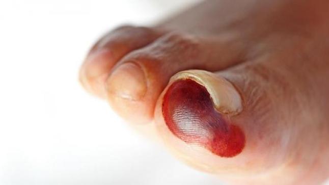 غرغرينا أعراضها وعلاجها وأماكن ظهورها